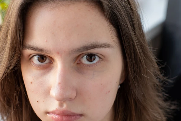 Close-up portrait of a teenage girl with mild acne and natural skin texture, highlighting common adolescent skin concerns.